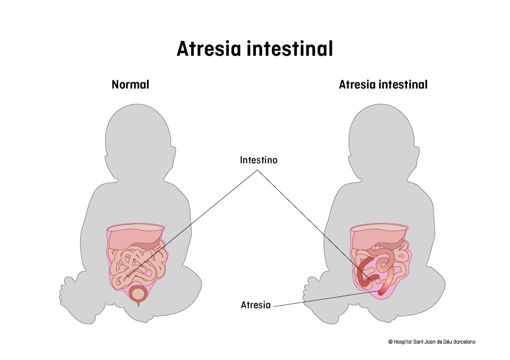 Atresia intestinal | Escola de Salut SJD